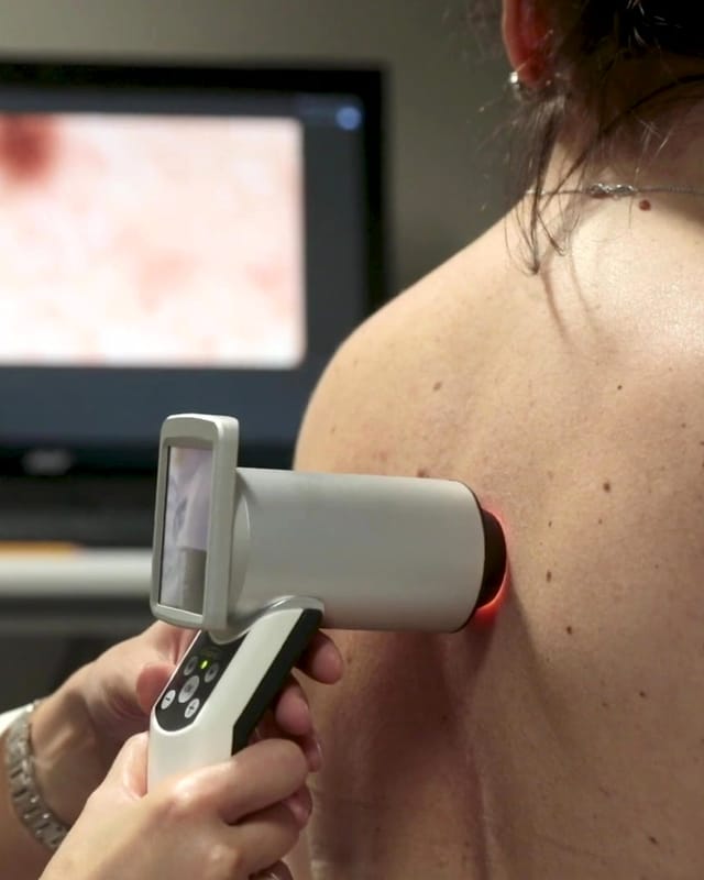 Una dermatologa appoggia il dermatoscopio digitale sulla schiena di una paziente; sullo schermo il neo ingrandito